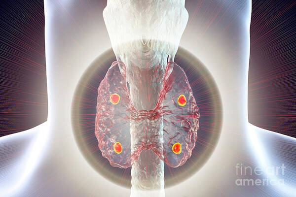 4 Art Print featuring the photograph Parathyroid Glands #4 by Kateryna Kon/science Photo Library