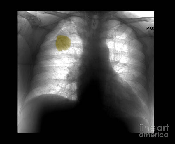 Chest Xray Art Print featuring the photograph Lung Cancer, X-ray by Living Art Enterprises