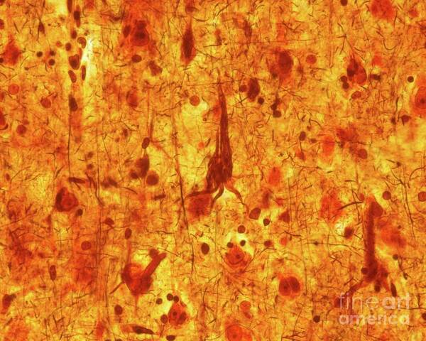 Pyramidal Neurons Art Print featuring the photograph Neurofibrillary Tangles #2 by Jose Calvo / Science Photo Library