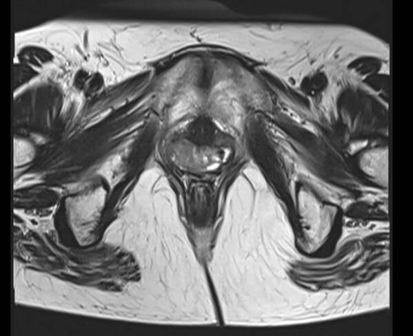 Care Art Print featuring the photograph Magnetic Resonance Images of Woman Pelvis with Vaginal cancer, axial T2 view by Paul Biris