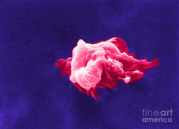 Scanning Electron Micrograph Art Print featuring the photograph Cancer Cell Death, Sem 6 Of 6 #1 by Science Source
