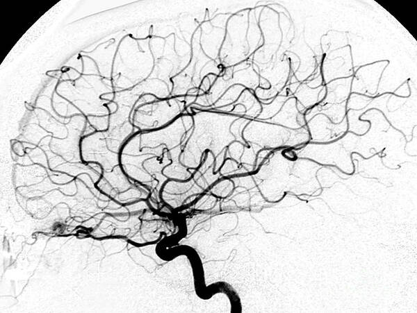 Cerebral Angiogram Art Print featuring the photograph Dural Arterial Venous Fistula, Angiogram by Living Art Enterprises
