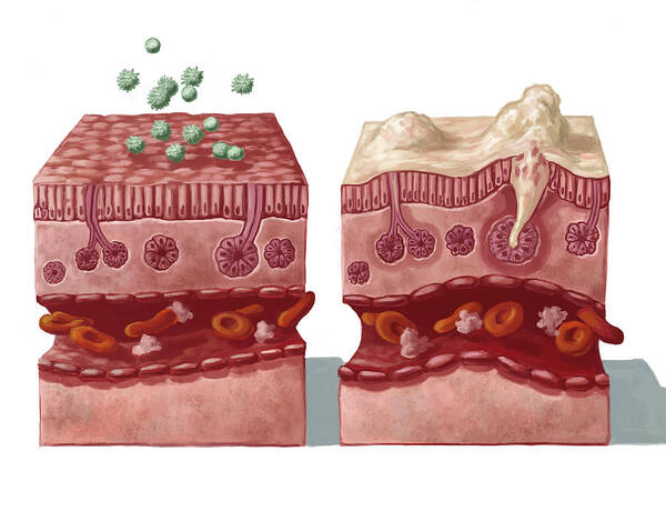 Allergens Art Print featuring the photograph Mucous Reaction To Allergens #1 by Spencer Sutton