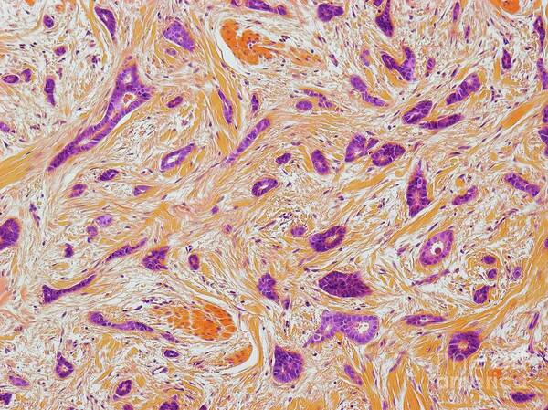 Breast Cancer Art Print featuring the photograph Breast Cancer #28 by Steve Gschmeissner/science Photo Library