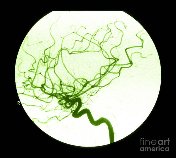 Cerebral Angiogram Art Print featuring the photograph Internal Carotid Cerebral Angiogram #1 by Medical Body Scans