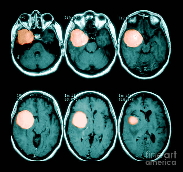 Mri Art Print featuring the photograph Brain Tumor by Medical Body Scans