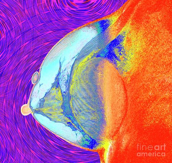 Breast Augmentation Art Print featuring the photograph Breast Augmentation #2 by K H Fung/science Photo Library