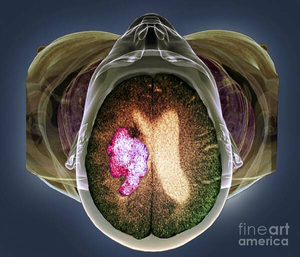Disease Art Print featuring the photograph Stroke, Mri And 3d Ct Scans by Zephyr