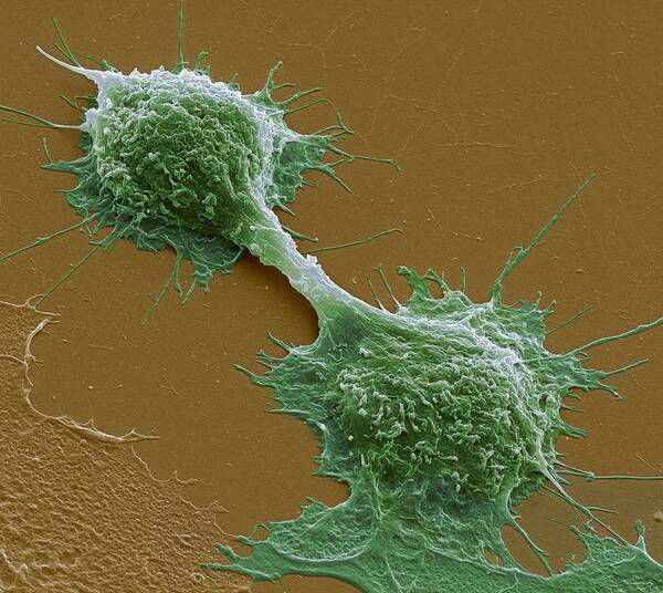 Cancer Cell Art Print featuring the photograph Dividing Cancer Cells, Sem #3 by Steve Gschmeissner