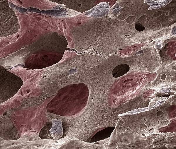 Spongy Bone Art Print featuring the photograph Scanning electron micrograph (SEM) of human bone, osteoporosis #1 by Science Photo Library - STEVE GSCHMEISSNER.