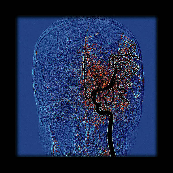 Abnormal Cerebral Arteriogram Art Print featuring the photograph Enhanced Temporal Lobe Hemorrhage #7 by Living Art Enterprises, LLC