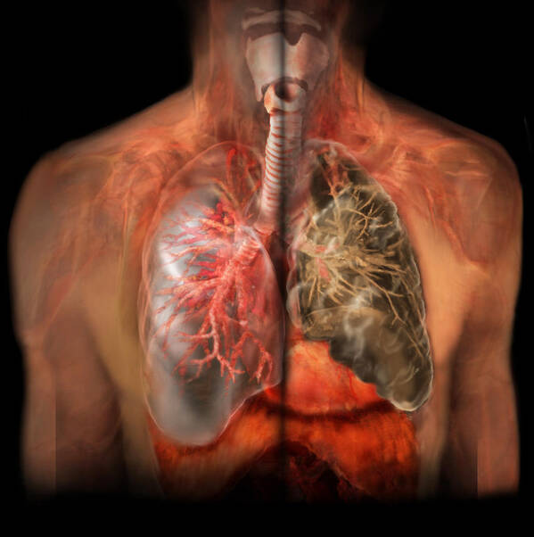Abnormal Art Print featuring the photograph Healthy Lung Vs. Smokers Lung by Anatomical Travelogue