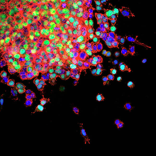Cell Art Print featuring the photograph Lung Cancer Metastasis by Winship Cancer Institute Of Emory University/national Cancer Institute/science Photo Library