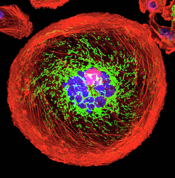 Cell Art Print featuring the photograph Polyploid Giant Cancer Cell From Breast by University Of Pittsburgh Cancer Institute/national Cancer Institute/science Photo Library