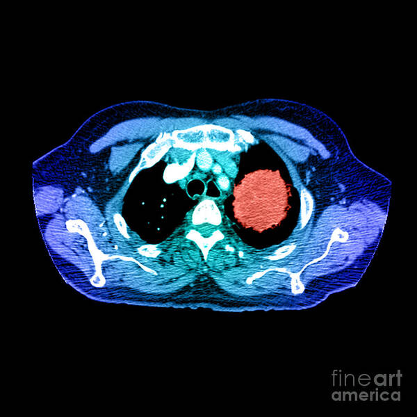 Axial Art Print featuring the photograph Lung Cancer #1 by Medical Body Scans