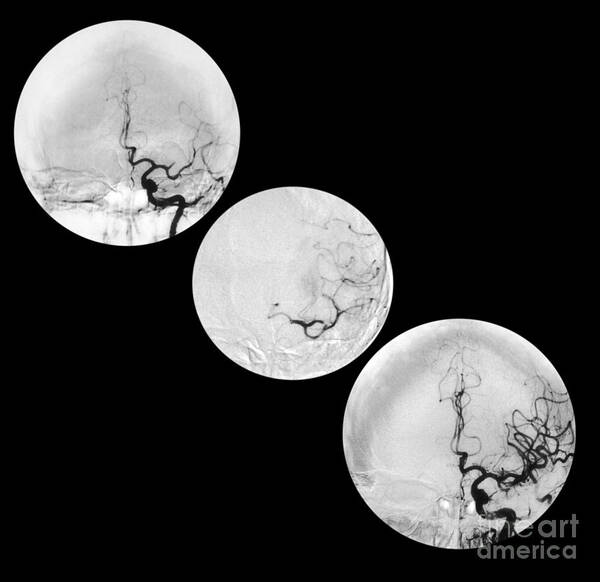 Angiogram Of Stroke Art Print featuring the photograph Stroke Treatment by Medical Body Scans
