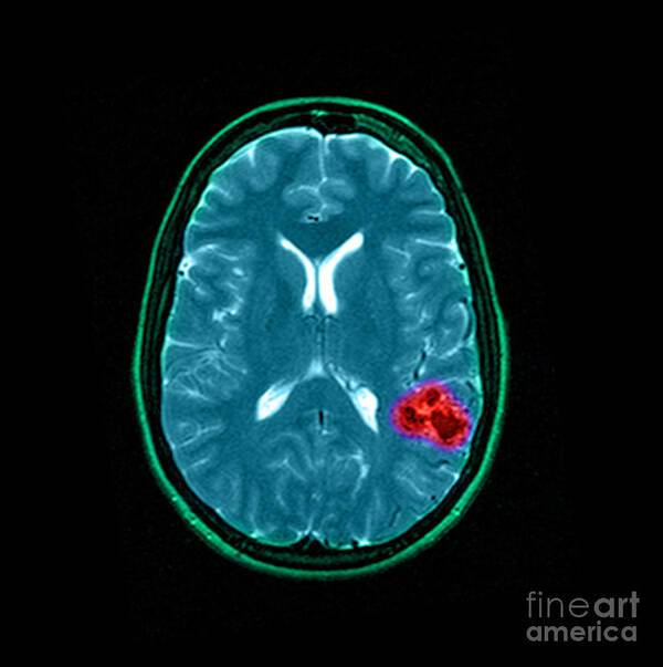 Abnormal Cerebral Blood Vessels Art Print featuring the photograph Mri Of Brain Avm #10 by Medical Body Scans