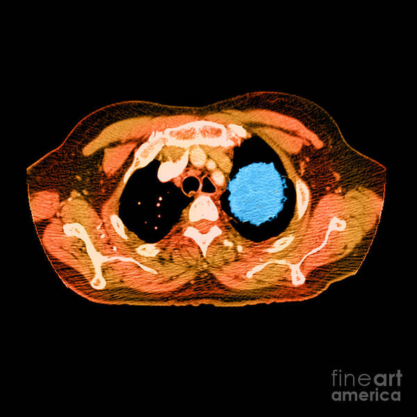 Axial Art Print featuring the photograph Lung Cancer #2 by Medical Body Scans