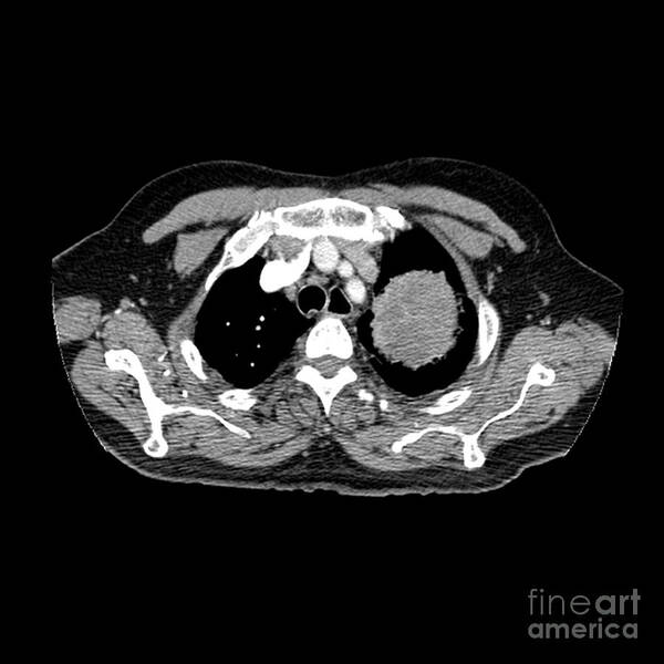 Spiral Ct Chest Art Print featuring the photograph Lung Cancer #3 by Medical Body Scans