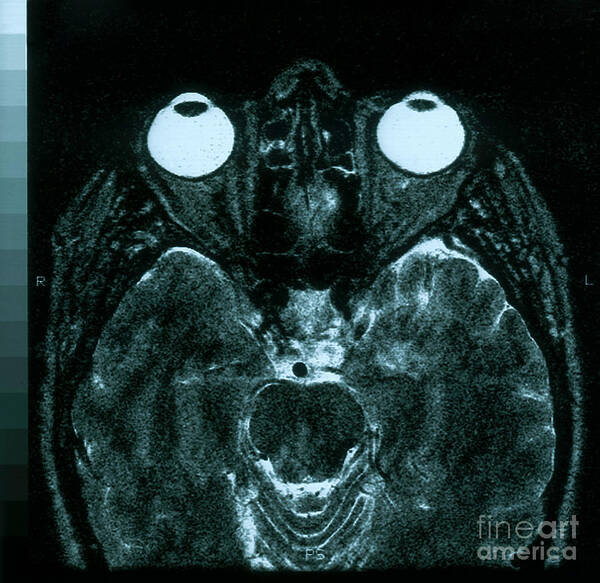 Brain Art Print featuring the photograph Mri Of Normal Brain #9 by Science Source