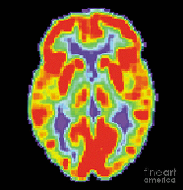 Diagnostic Art Print featuring the photograph Pet Scan Of Normal Brain, 1 Of 2 by Science Source
