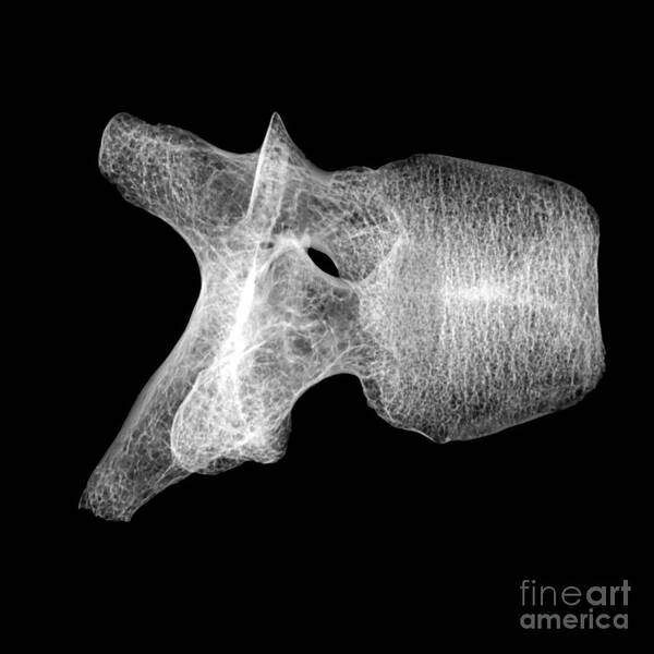 Science Art Print featuring the photograph Human Vertebra T5, X-ray #7 by Ted Kinsman