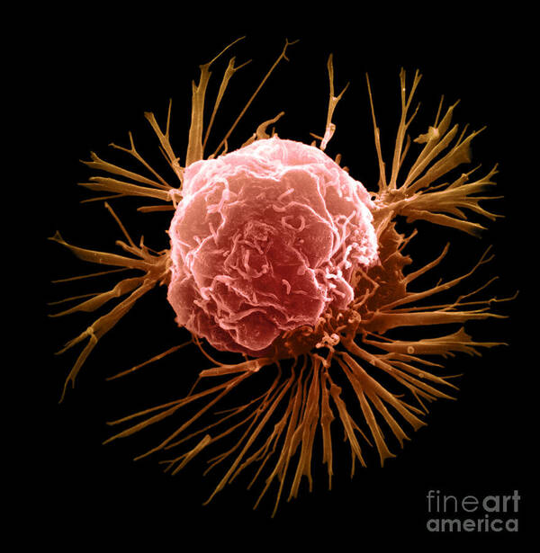 Sem Art Print featuring the photograph Breast Cancer Cell #6 by Science Source