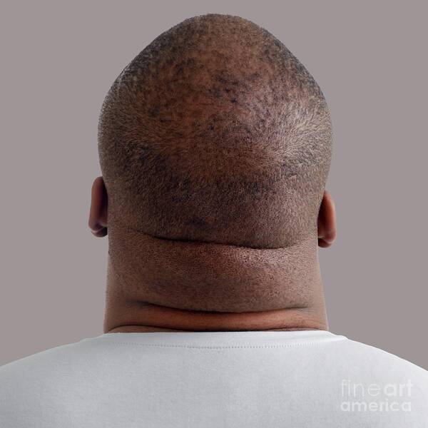 Close Up Art Print featuring the photograph Close Up Of Overweight Man's Neck by Science Photo Library