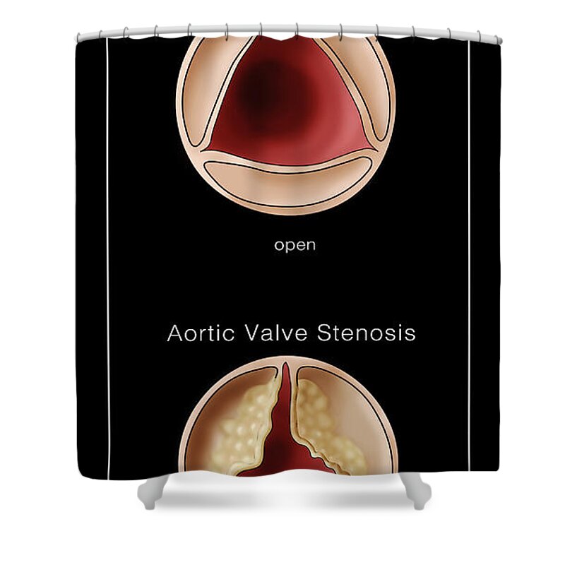 Illustration Shower Curtain featuring the photograph Aortic Valve, Normal & Stenosis #1 by Monica Schroeder