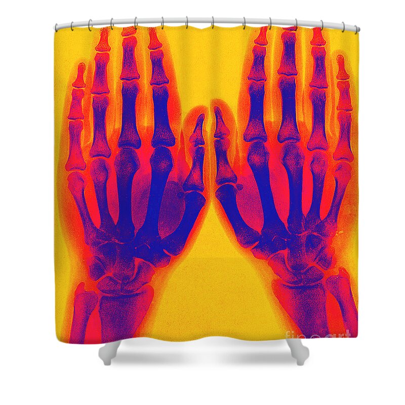 Historic Shower Curtain featuring the photograph X-ray Of Two Normal Hands 1896 #3 by Science Source