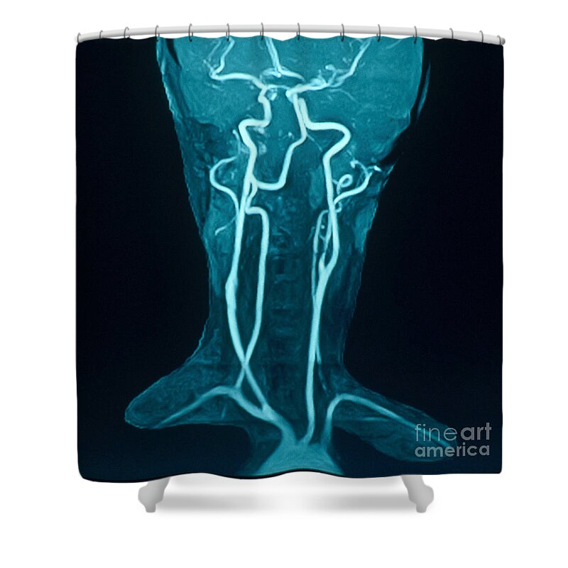 Medical Shower Curtain featuring the photograph Circle Of Willis by Susan Leavines