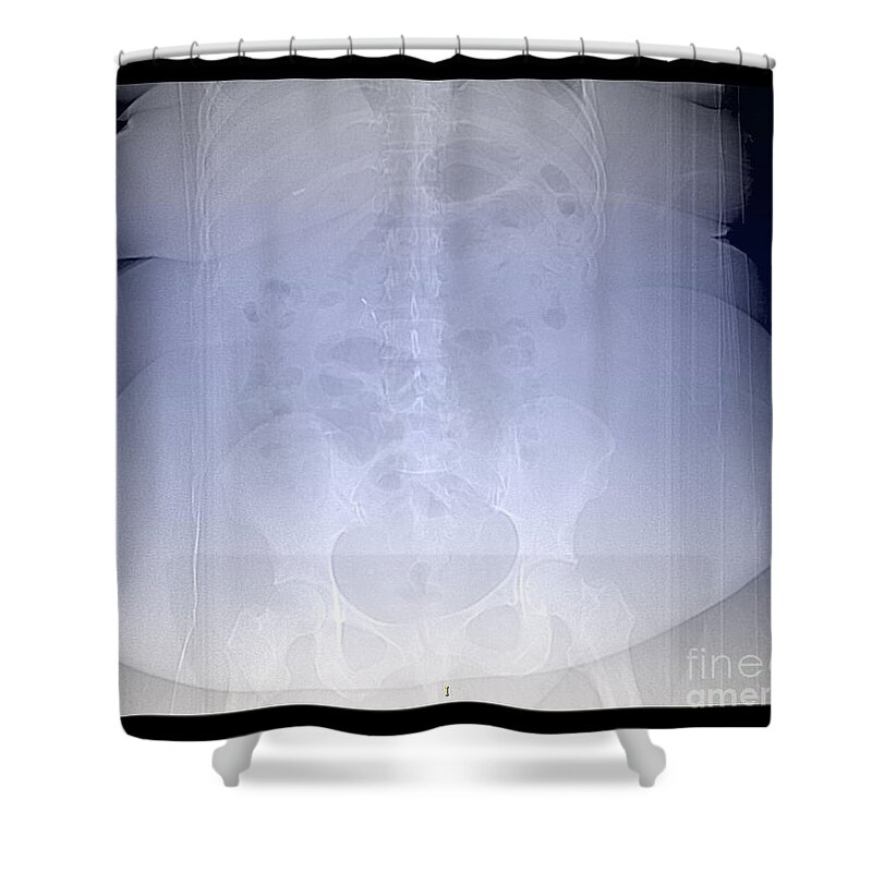 Science Shower Curtain featuring the photograph X-ray Of Morbidly Obese Patient #3 by Living Art Enterprises