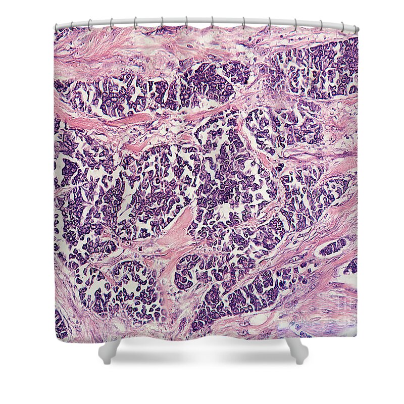 Papillary Shower Curtain featuring the photograph Ductal Breast Carcinoma, Lm by Garry DeLong