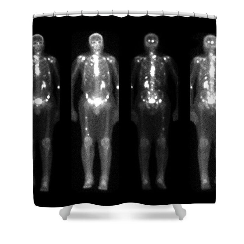 Bone Scan Shower Curtain featuring the photograph Nuclear Bone Scans Of Cancer Patients by Medical Body Scans