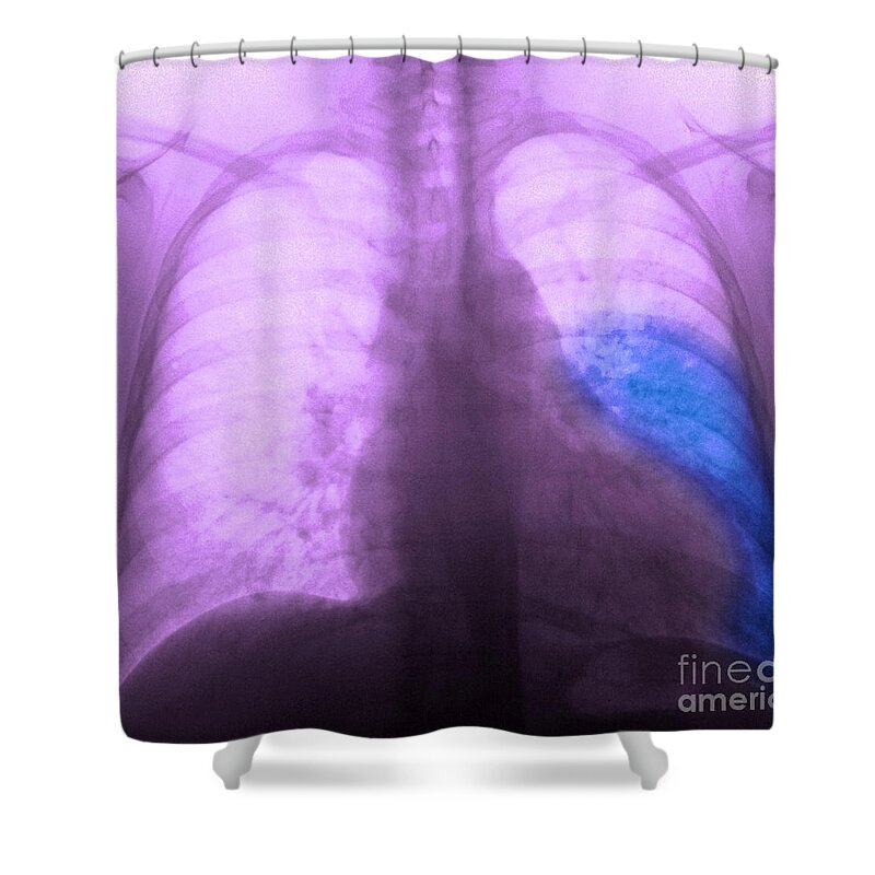 X Ray Shower Curtain featuring the photograph Pneumonia, X Ray by Scott Camazine