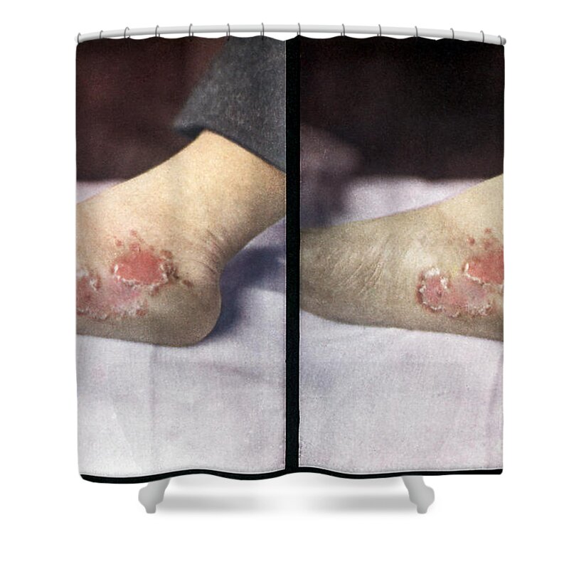 Science Shower Curtain featuring the photograph Tertiary Syphilis, Vintage Stereoscopic by DoubleVision
