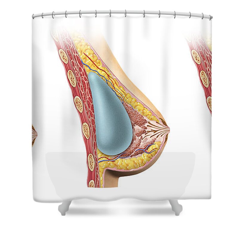 Woman Breast Implant Cross Section Shower Curtain