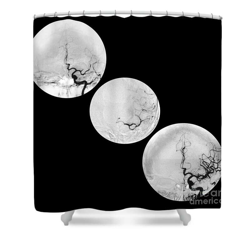Angiogram Of Stroke Shower Curtain featuring the photograph Stroke Treatment by Medical Body Scans