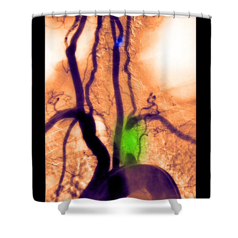 Abnormal Angiogram Shower Curtain featuring the photograph Aortic Arch Angiogram #2 by Medical Body Scans