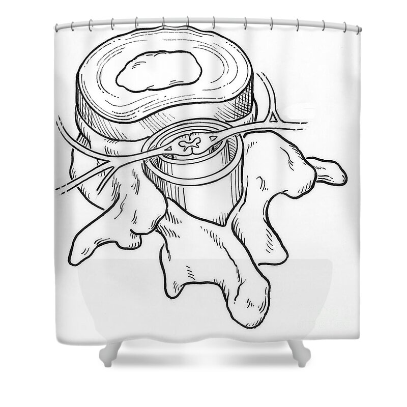 Anatomy Shower Curtain featuring the photograph Illustration Of Spinal Disk #2 by Science Source