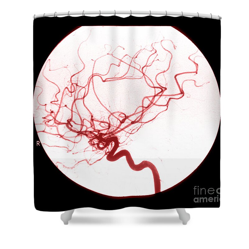 Cerebral Angiogram Shower Curtain featuring the photograph Internal Carotid Cerebral Angiogram #2 by Medical Body Scans