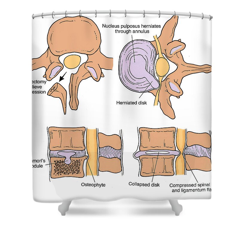 Anatomy Shower Curtain featuring the photograph Illustration Of Spinal Disk Pathologies #6 by Science Source