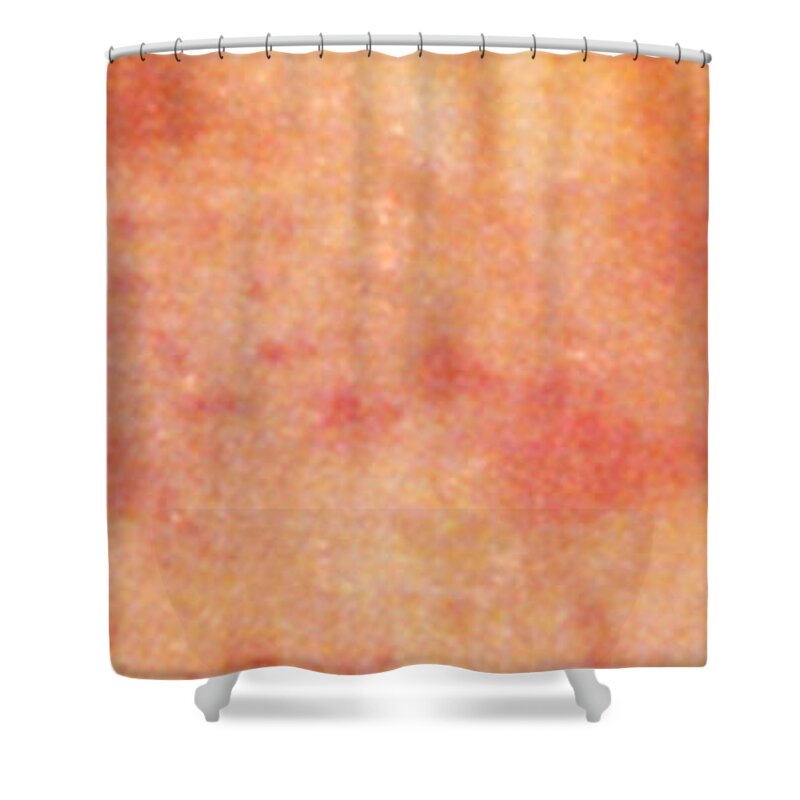 Psoriasis Chest Shower Curtain featuring the photograph Acute Psoriasis by Science Source
