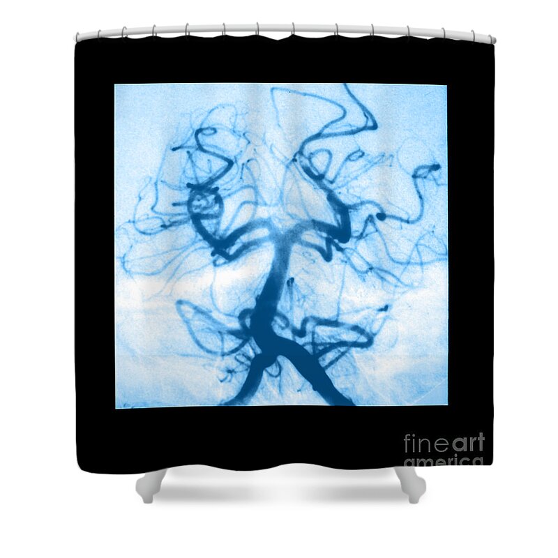Abnormal Cerebral Angiogram Shower Curtain featuring the photograph Angiogram Of Embolus In Cerebral Artery by Medical Body Scans