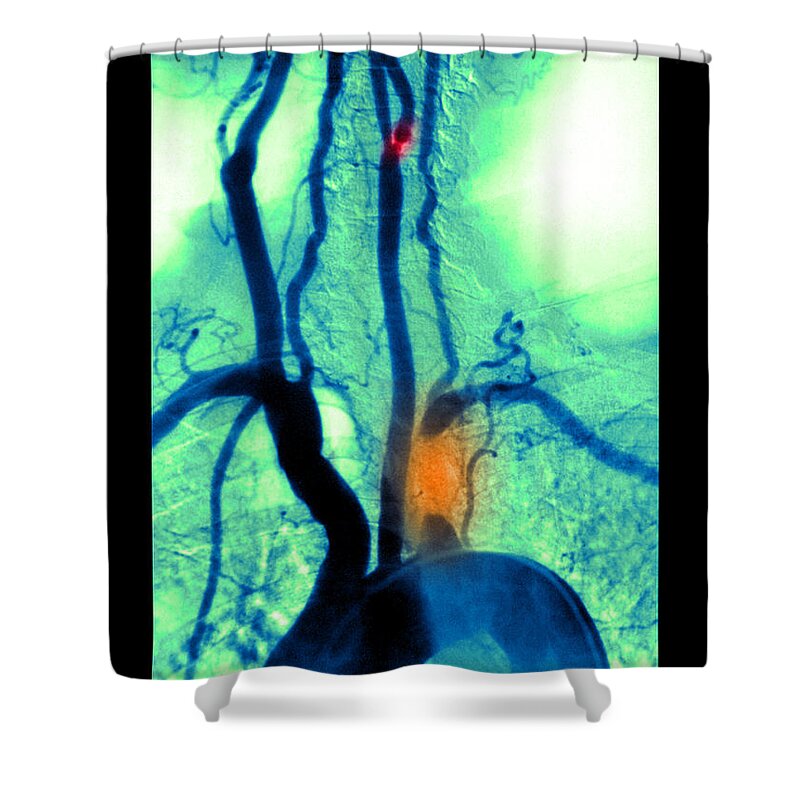 Abnormal Angiogram Shower Curtain featuring the photograph Aortic Arch Angiogram by Medical Body Scans