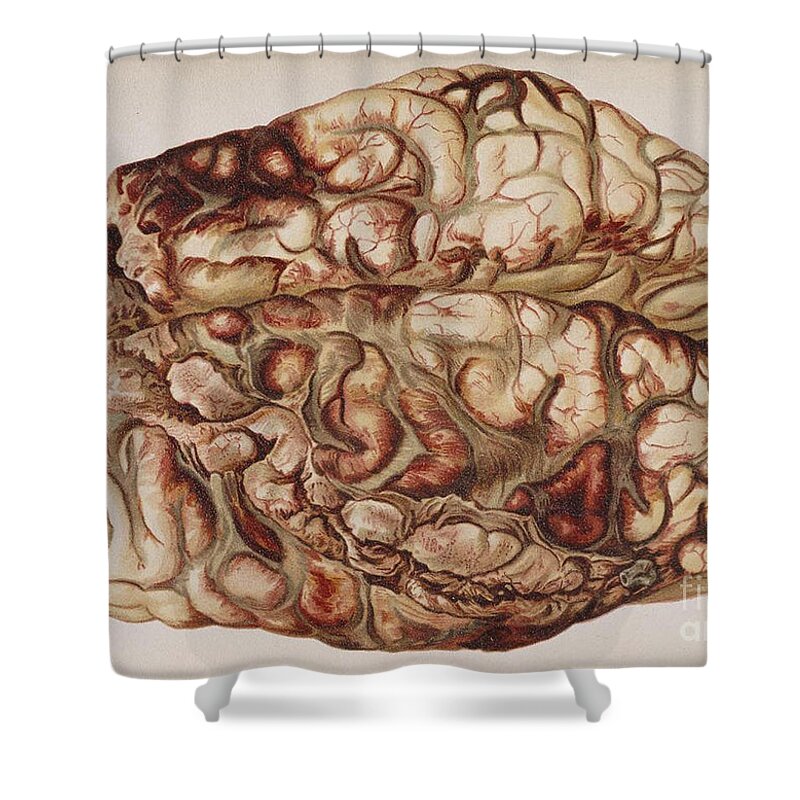 Science Shower Curtain featuring the photograph Encircling Gunshot-wound In Brain, 1898 by Science Source