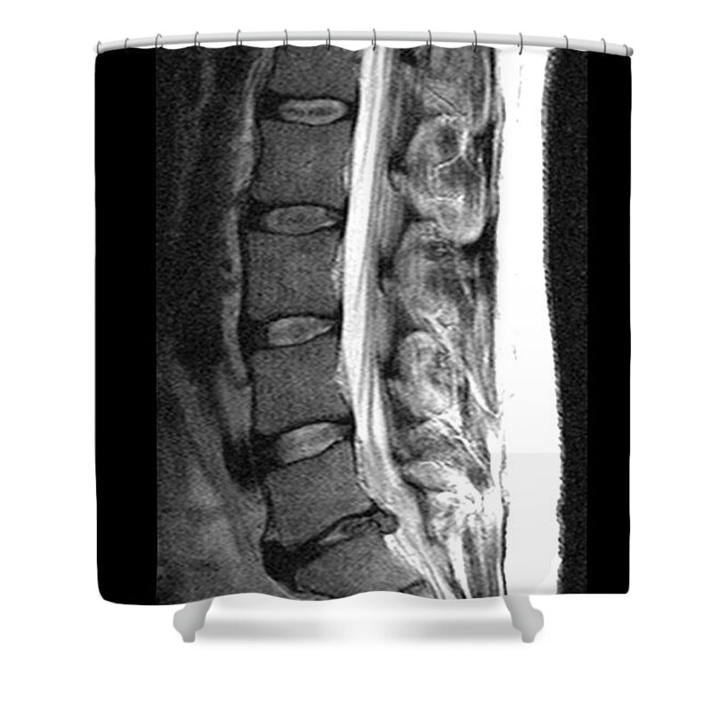 Mri Shower Curtain featuring the photograph Herniated Disc by Medical Body Scans