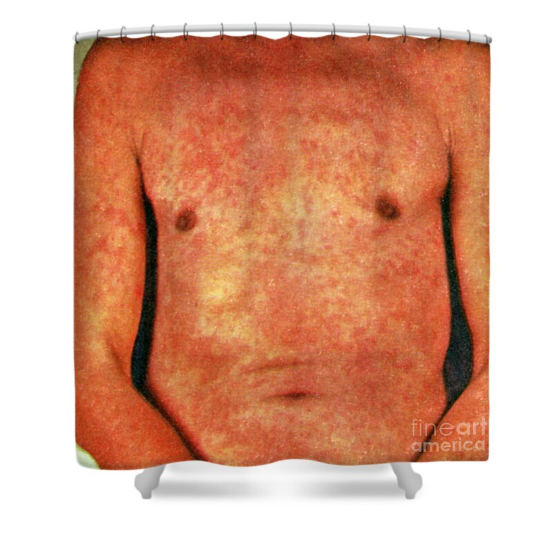 Skin Shower Curtain featuring the photograph Miliaria by Science Source