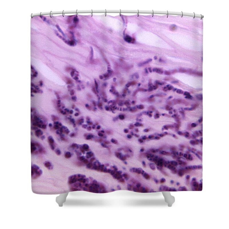 Science Shower Curtain featuring the photograph Pitted Keratolysis, Lm by Science Source