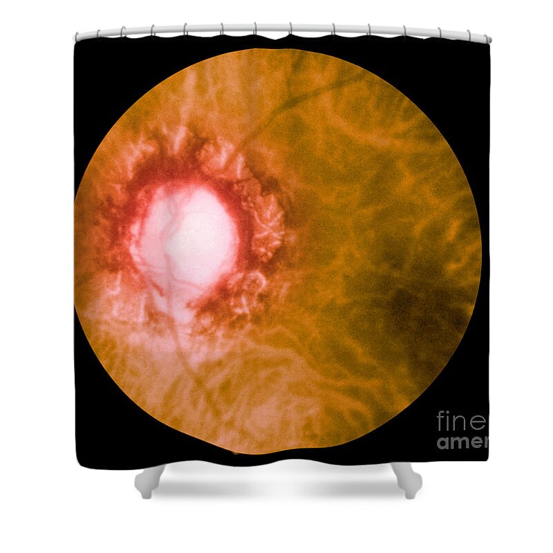Bacteria Shower Curtain featuring the photograph Retina Infected By Syphilis by Science Source